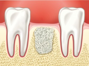 Костная пластика при имплантации