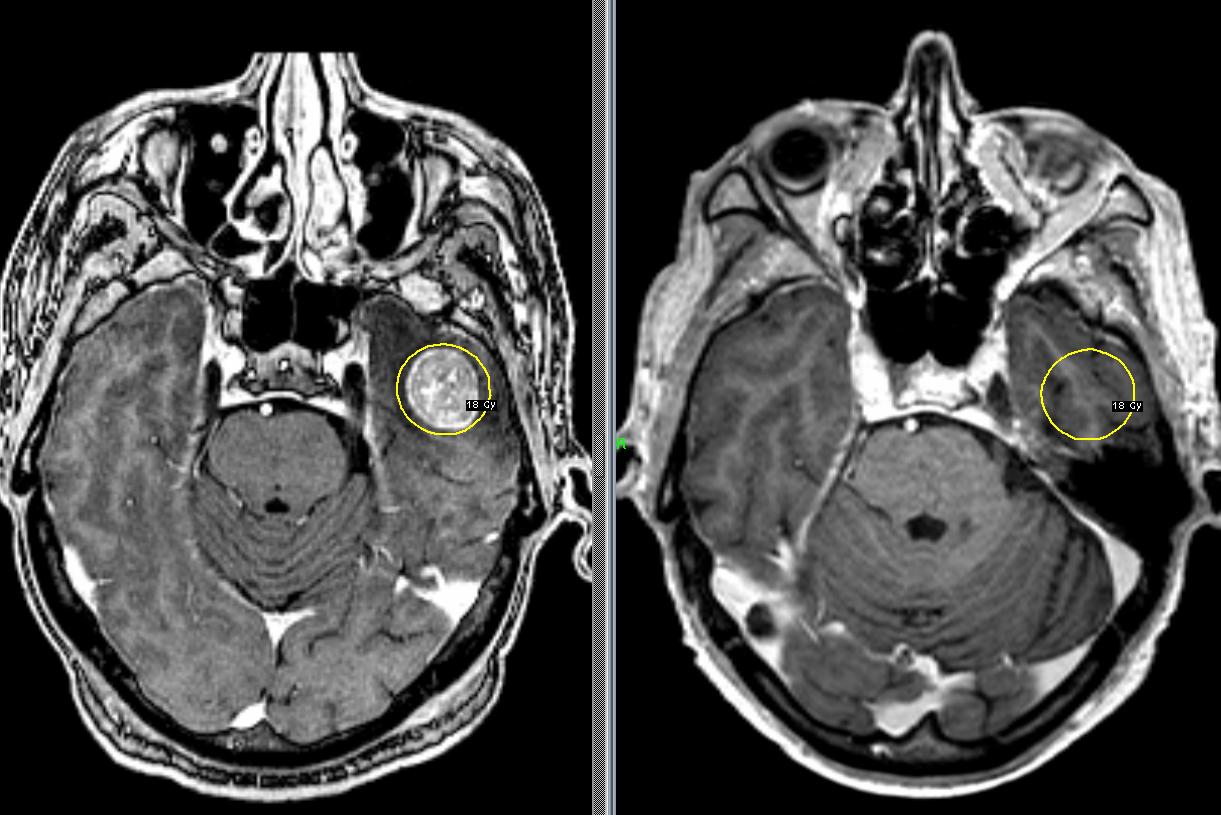 Патологии на мрт. Гемангиобластома мозжечка мрт. Опухоль головного мозга снимок мрт. Тератома головного мозга мрт. Метастазы головного мозга на снимке мрт.